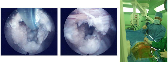 내시경 수술 장면: 고주파나 레이저를 사용하여 제거된 디스크를 마무리 하는 모습