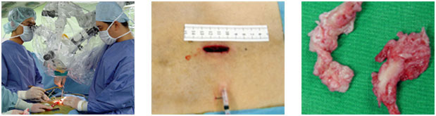 미세 현미경 디스크 수술장면, 피부절개 크기: 3cm, 제거된 디스크 사진