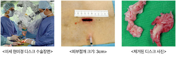 미세 현미경 디스크 수술장면, 피부절개 크기: 3cm, 제거된 디스크 사진